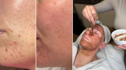 2025_10_23-Einde-van-het-jaar-gebruik-je-vergoeding-voor-acnebehandelingen-nog