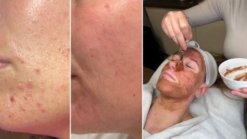 2025_10_23-Einde-van-het-jaar-gebruik-je-vergoeding-voor-acnebehandelingen-nog