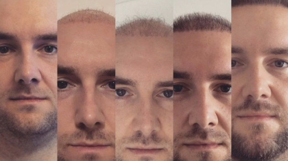 Haartransplantatie-via-Wills-Hairstyling-Barbershop